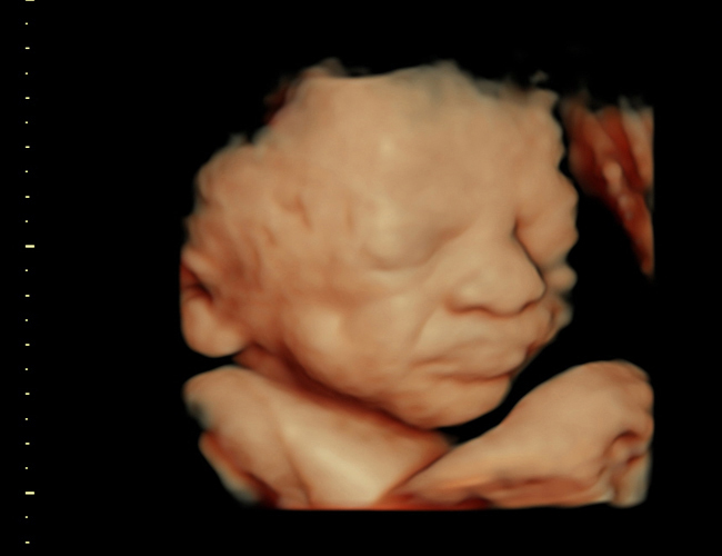 3D ultrasound image at 31 weeks